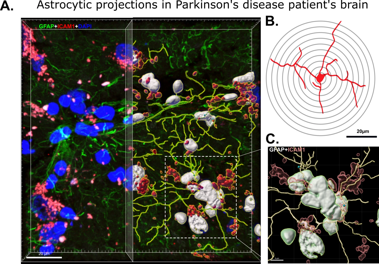 Avbildningar av olika astrocytprojektioner i Parkinsons sjukdom i patientens hjärna