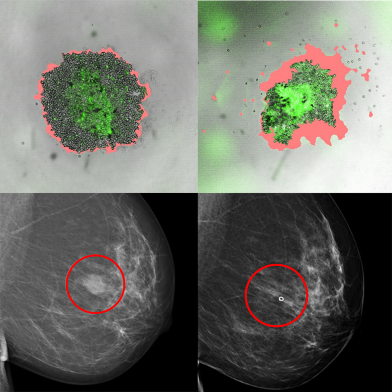 Ny Metod Hittar Rätt Behandling Till Bröstcancerpatienter | Karolinska ...