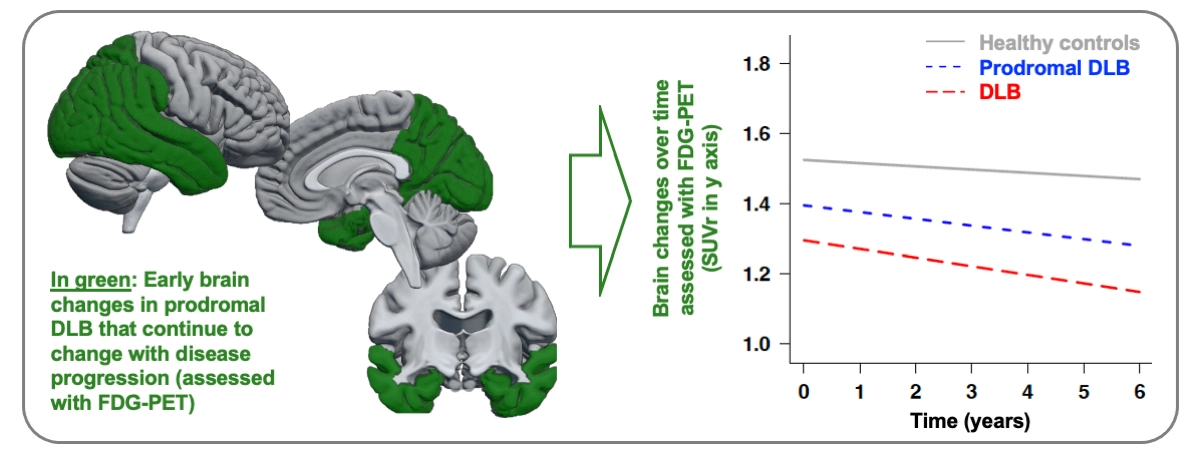 Figur med hjärnans nedbrytning vid demens Lewy Body till studien ”Longitudinal FDG-PET Metabolic Change Along the Lewy Body Continuum”.