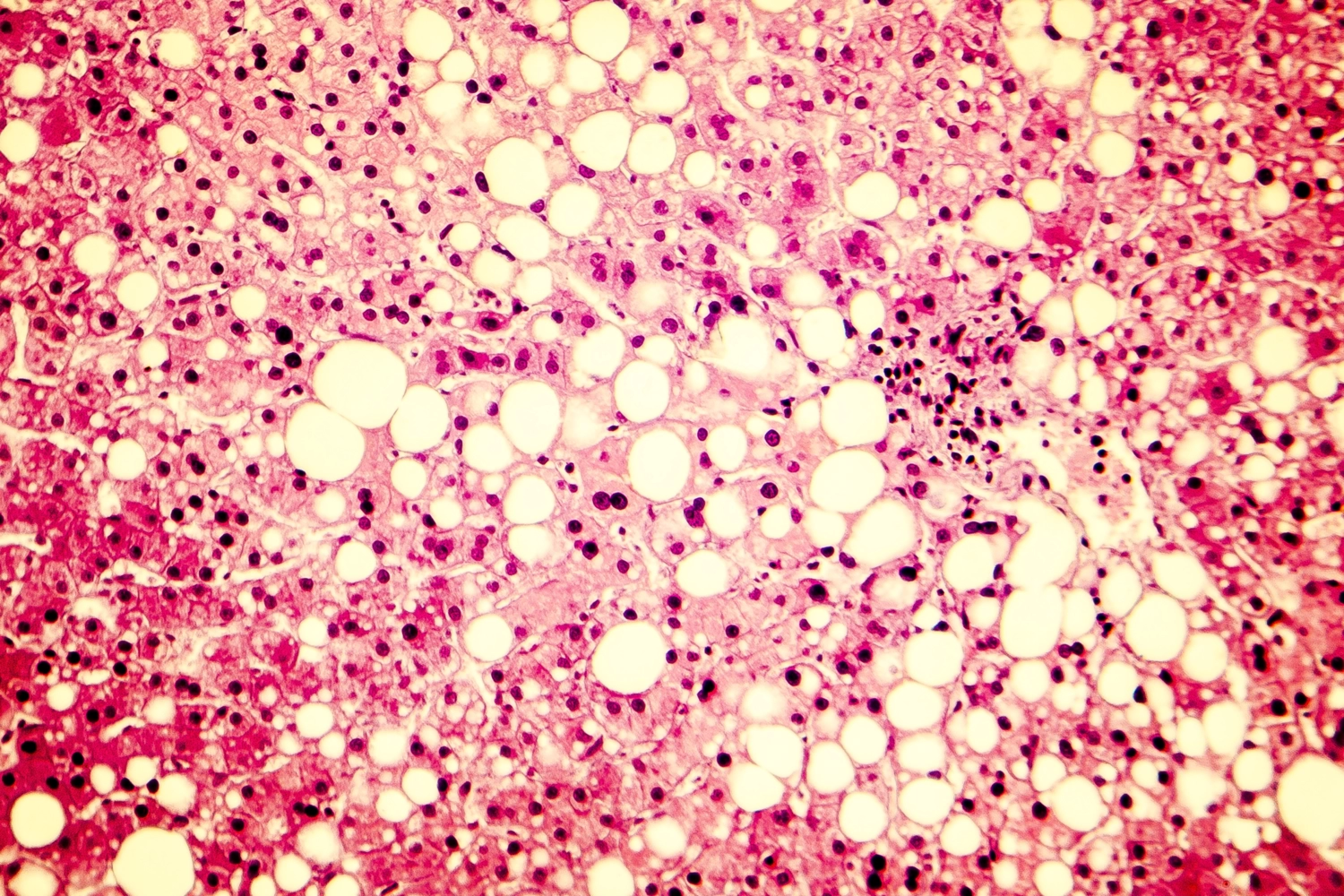 Levercancer och allvarlig leversjukdom vanligare om fettlever finns i ...