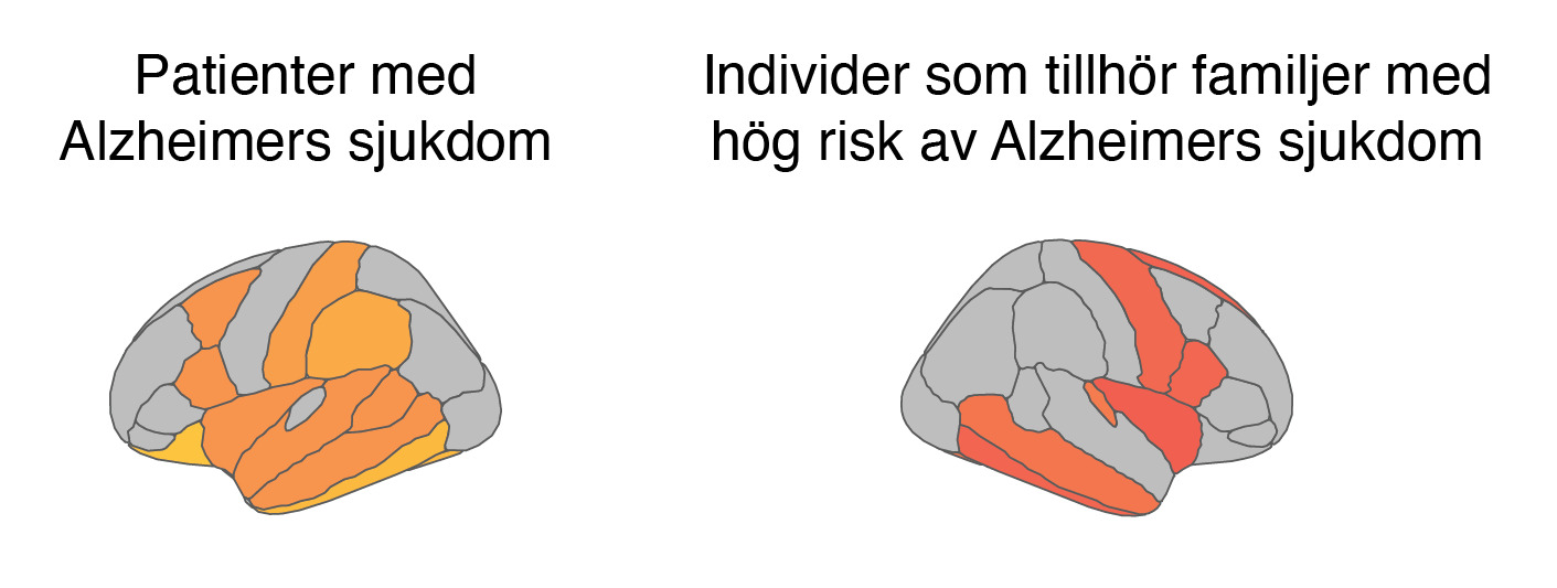 Illustrationer av två hjärnor, den ena av en patirent med <Alzheimers sjukdom och den andra av individer som tillhör familjer med hög risk av Alzheimers sjukdom.