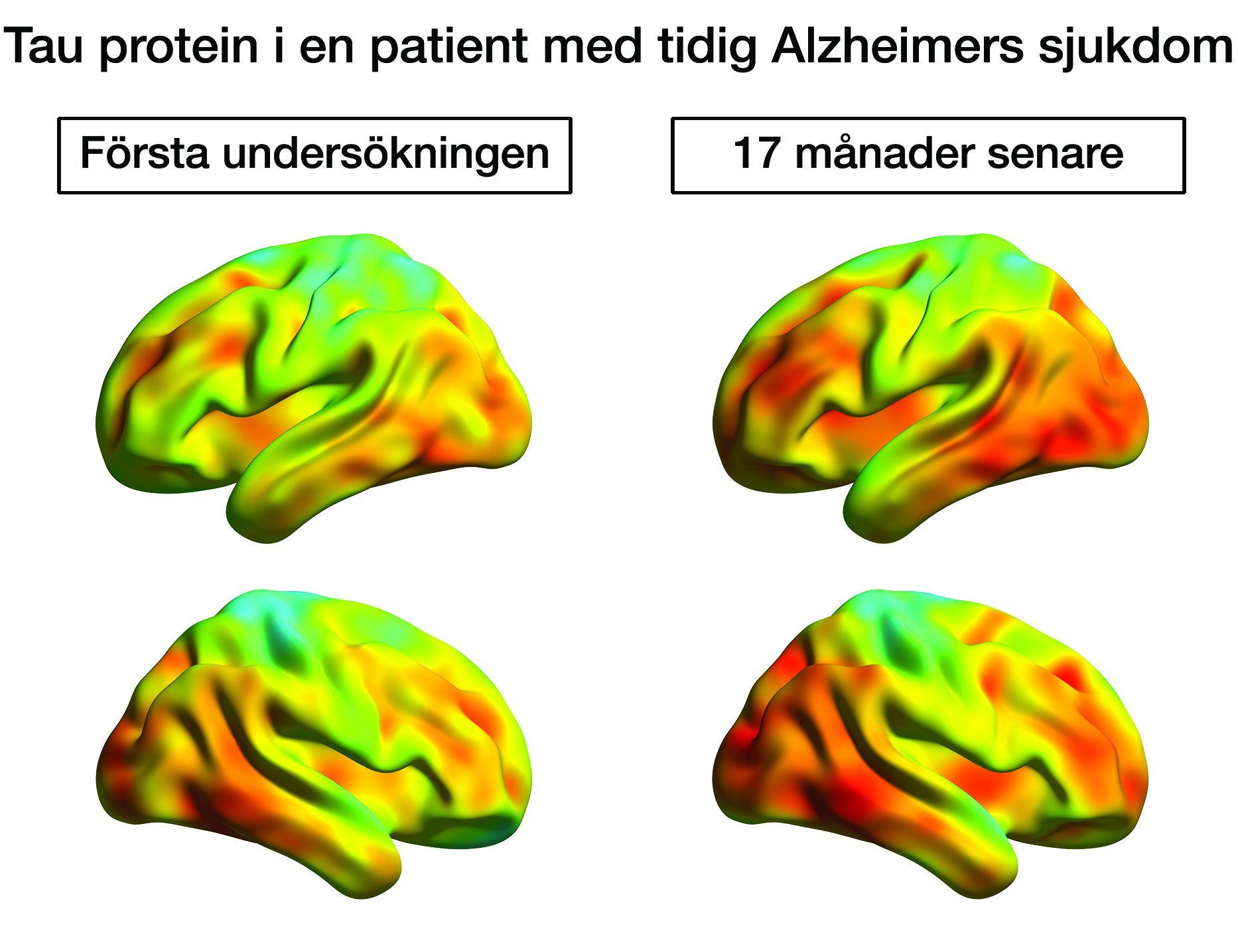 PET-undersökning visar hur tauansamlingar sprids i hjärnan under förloppet av Alzheimers sjukdom. Foto:Nordberg/Chiotis etal.