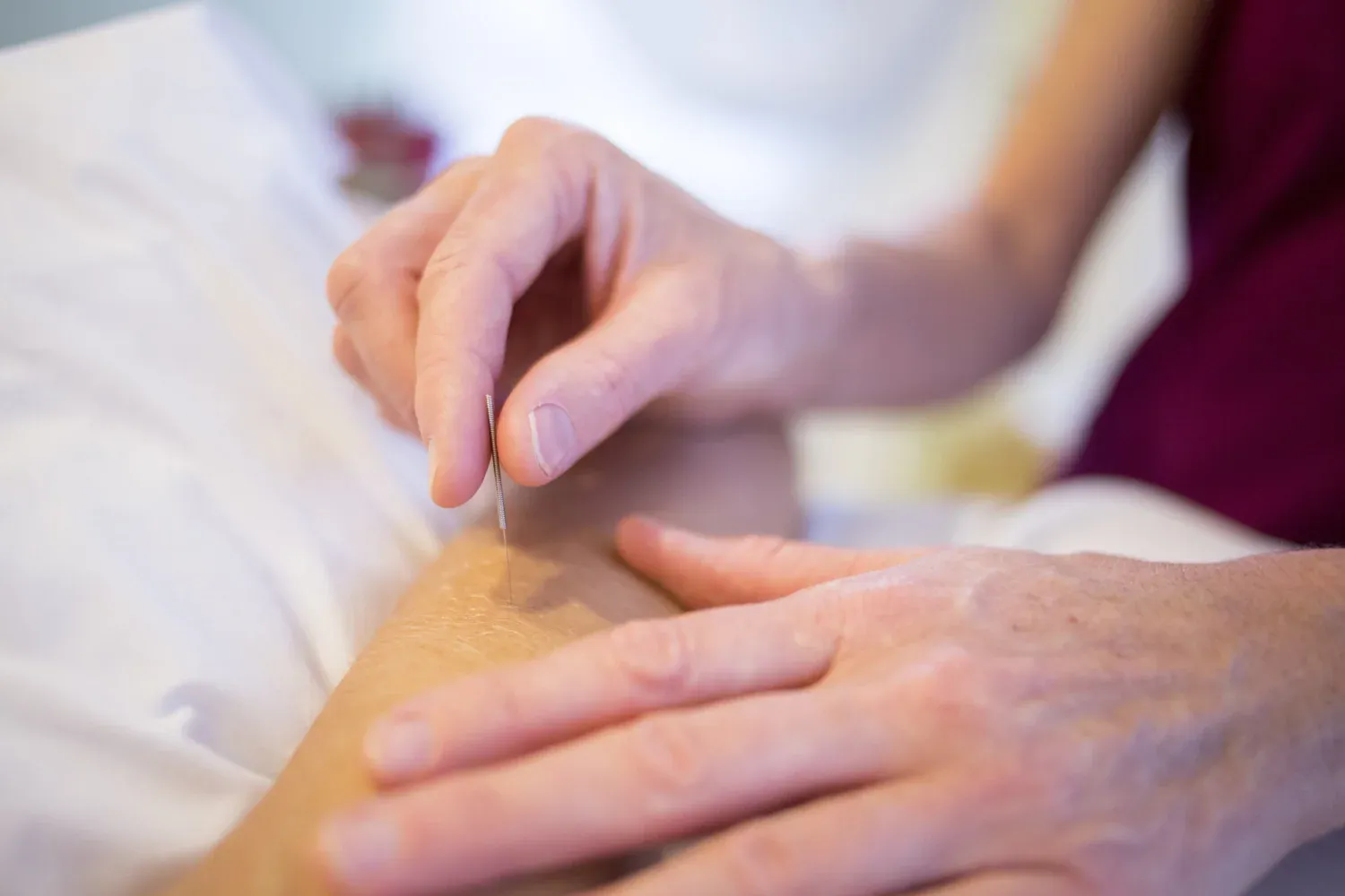 Hand som sätter in akupunkturnål på person.