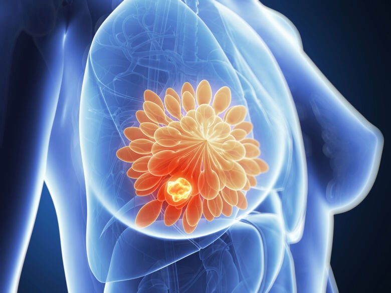 3D rendering av en tumör i bröstet.