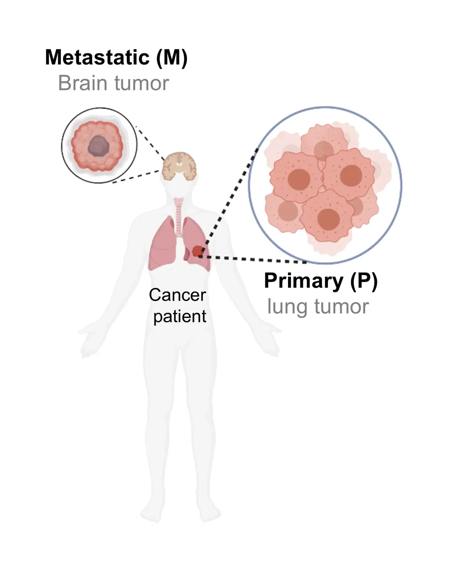 Schematisk illustration av matchad NSCLC primär tumör och hjärnmetastaser hos cancerpatienter.