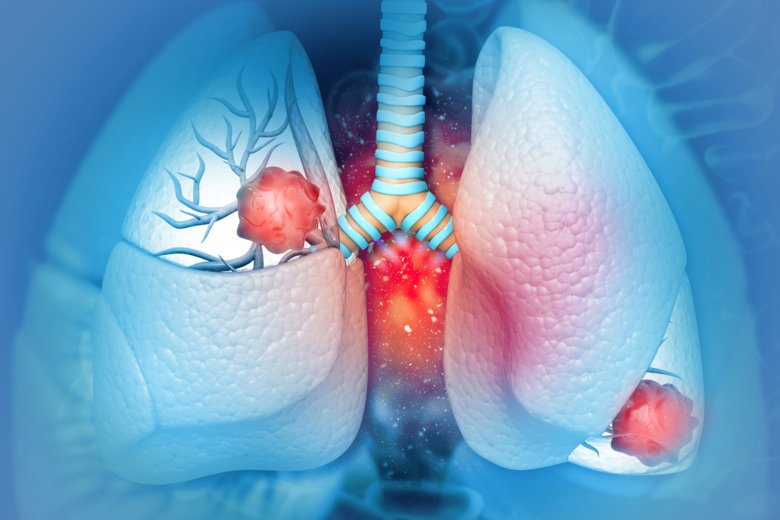 Illustration av lungcancer