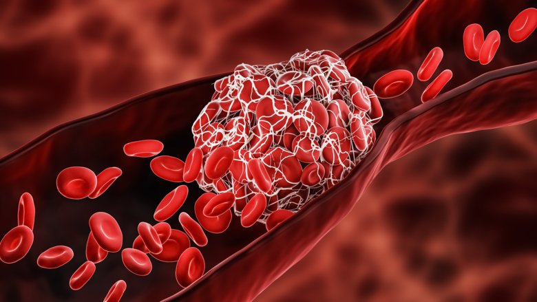 Illustration av en blodpropp i ett blodkärl.