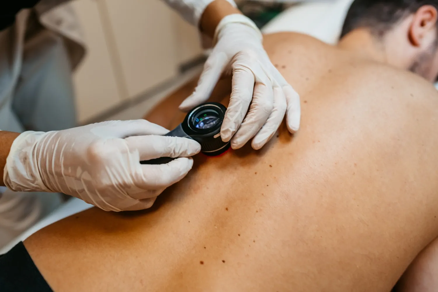 Läkare undersöker en patients födelsemärken på ryggen.
