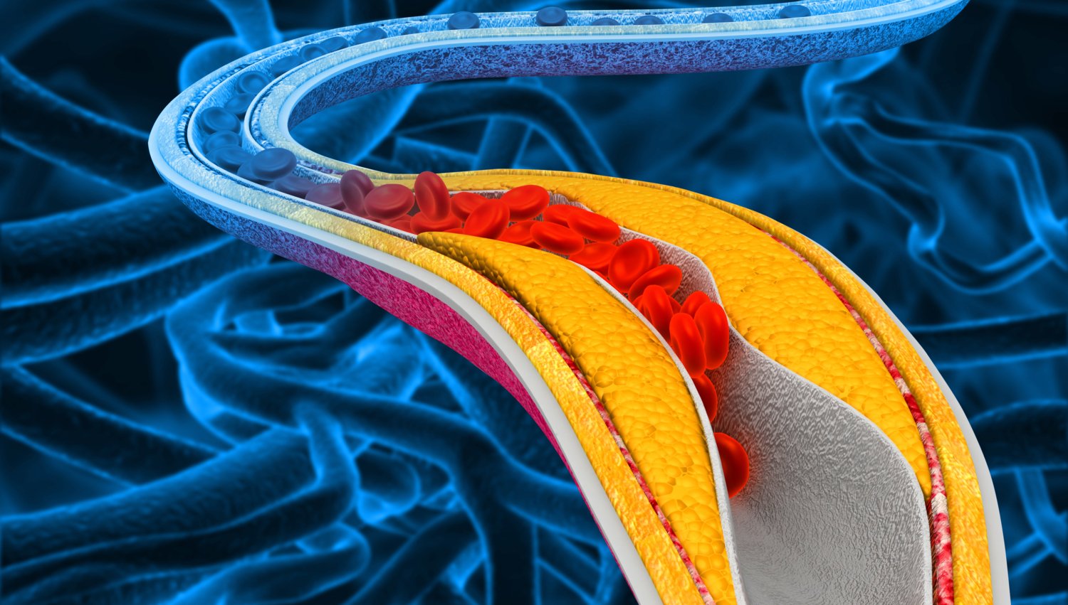 Illustration av plack i blodkärl