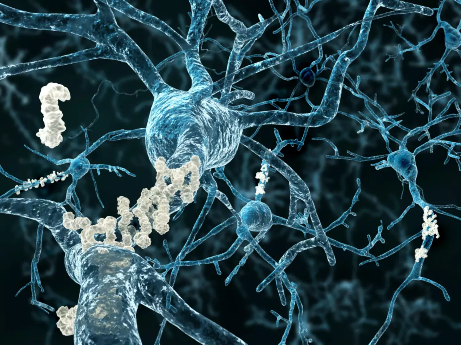 Amyloida plack i hjärnan vid Alzheimers sjukdom