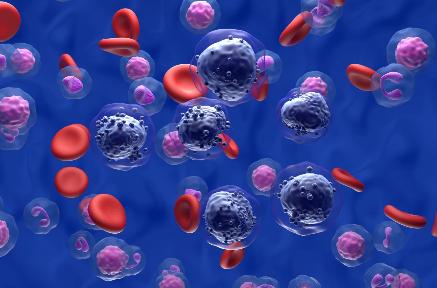 Illustration av akut myeloisk leukemi (AML)-celler i blodflödet
