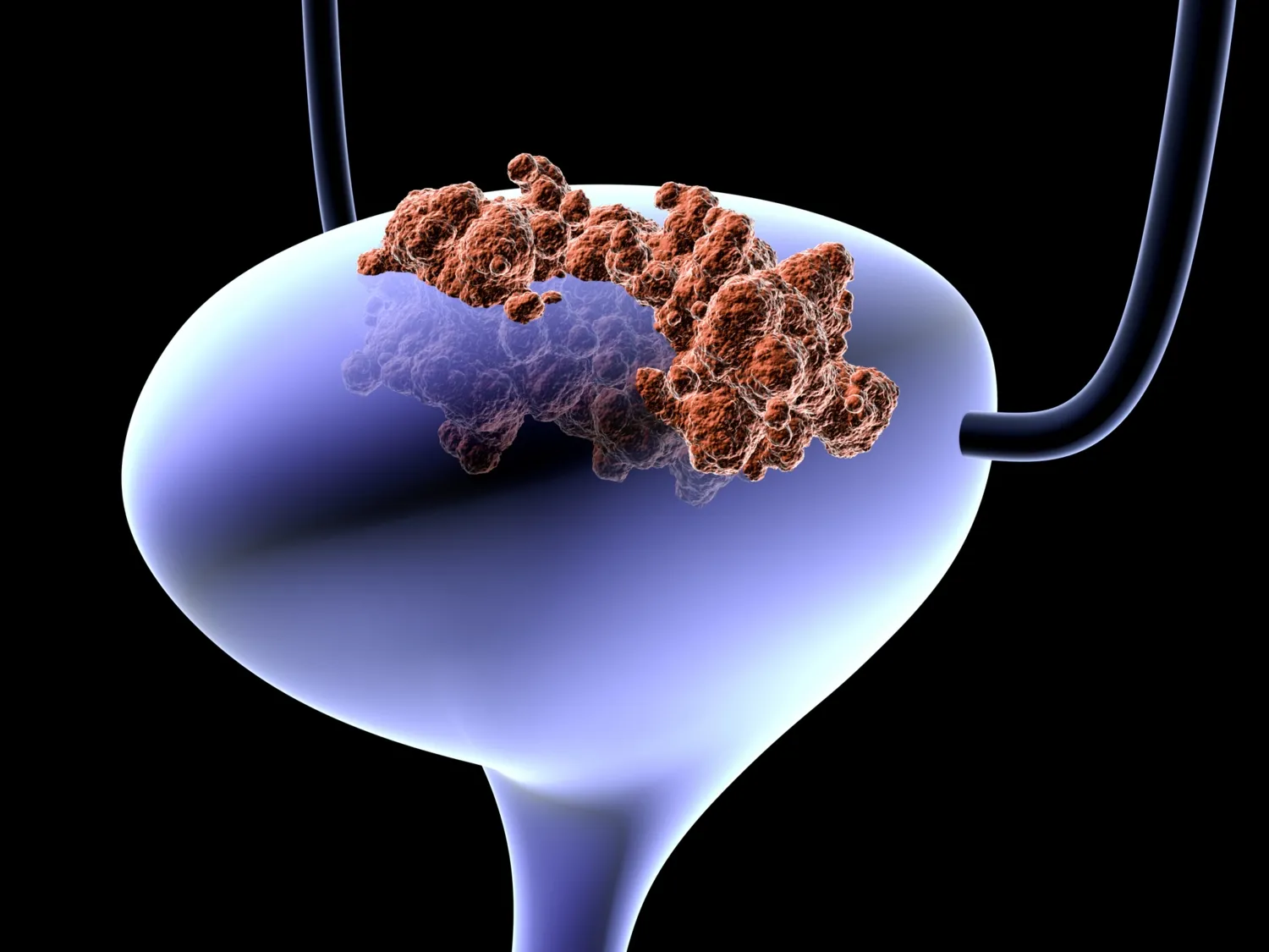 Illustration av urinblåsa med tumör.