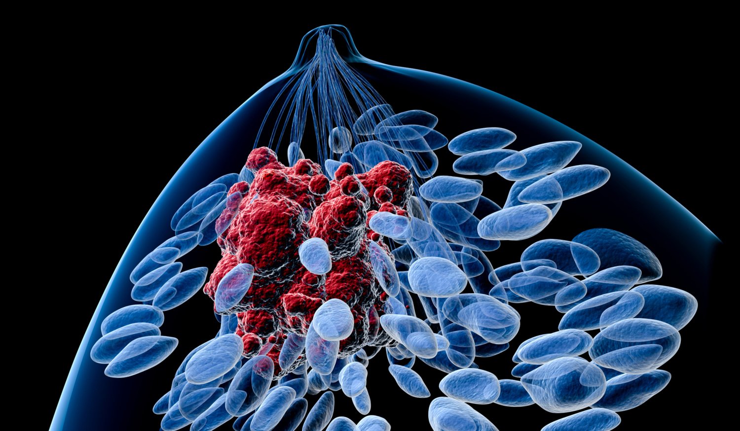 Illustration som visar bröstcancertumör.