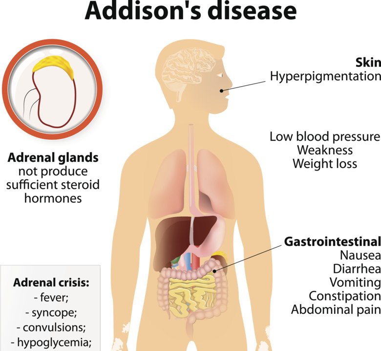 Illustration av symptom associerade med Addisons sjukdom. Symtomen inkluderar trötthet, aptitlöshet, viktnedgång, pigmenterad hy och yrsel på grund av lågt blodtryck.