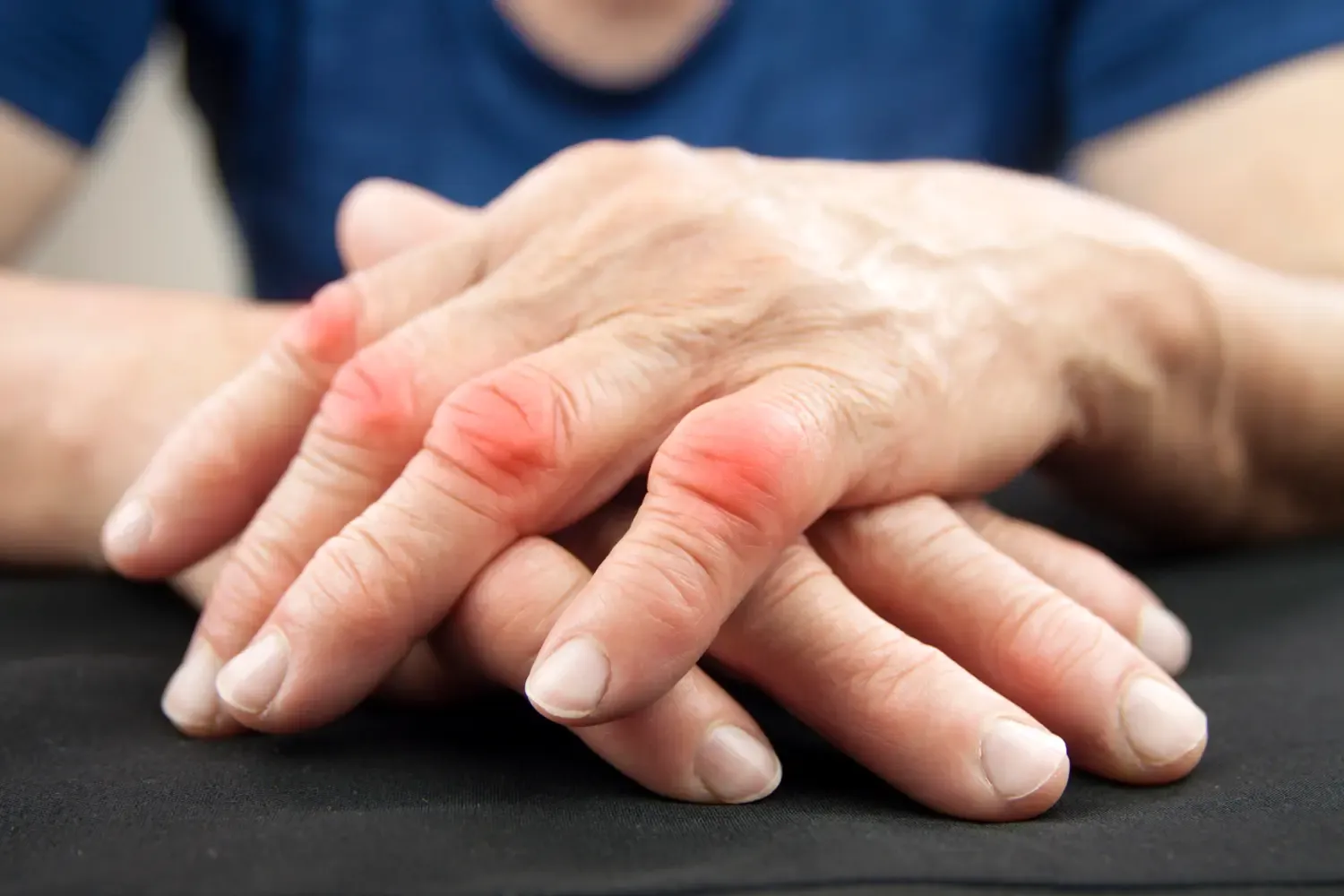 Artros fingrarnas mellanleder