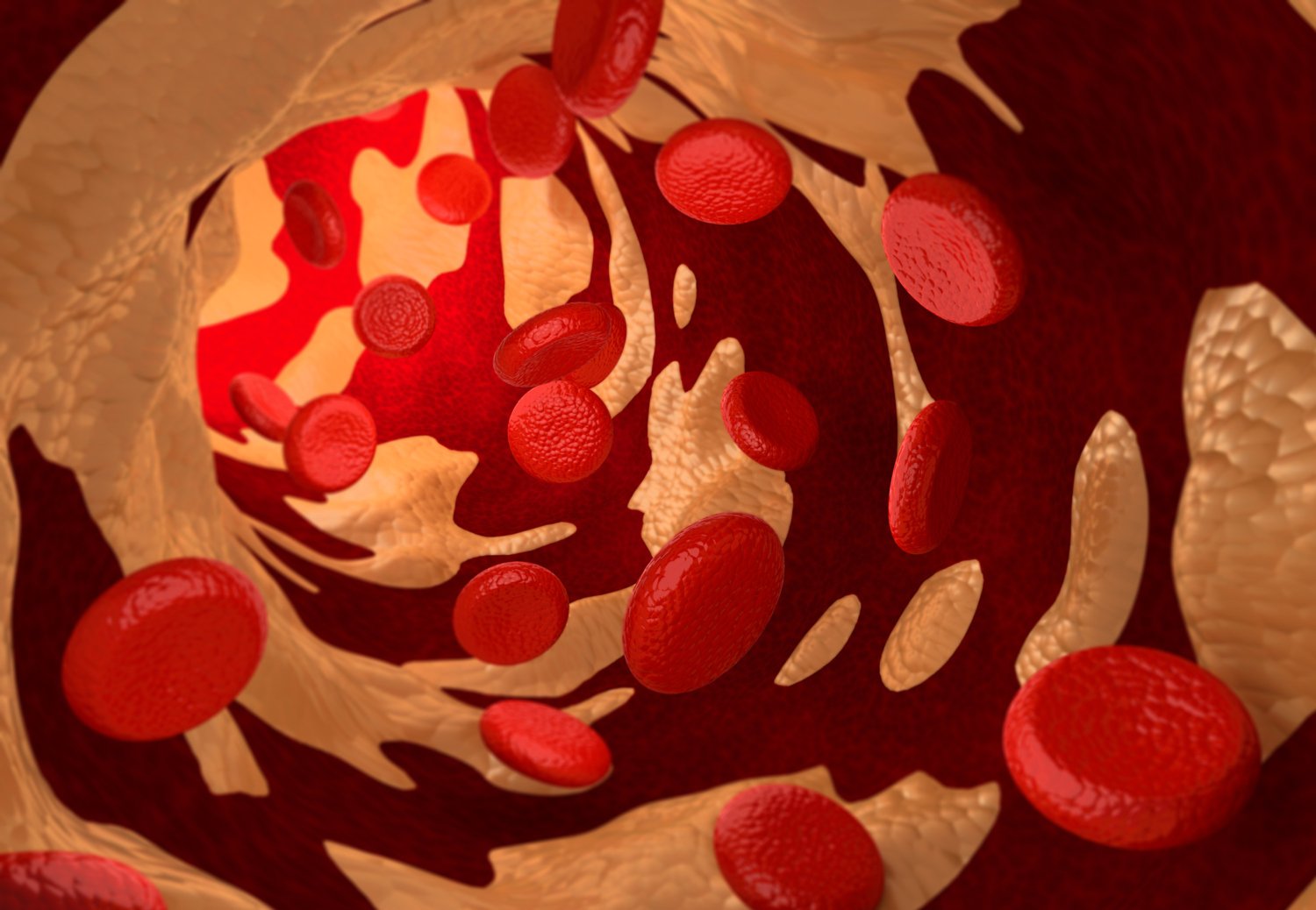 3D-rendering av arterioskleros orsakad av kolesterolplack.