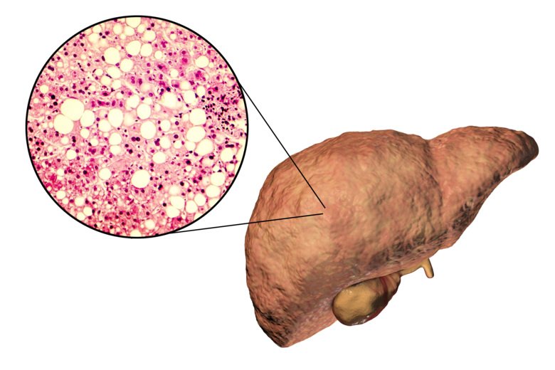 Illustration of fatty liver disease