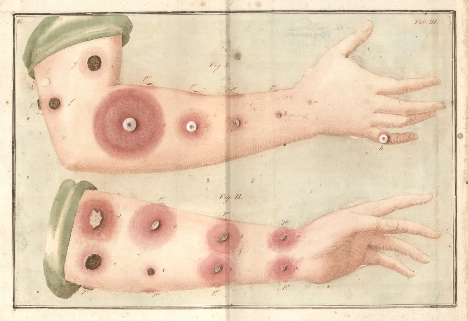 Medicinsk bild av en arm från: Sacco, Luigi: Trattato di vaccinazione con osservazioni sul giavardo e vajuolo pecorino, 1809