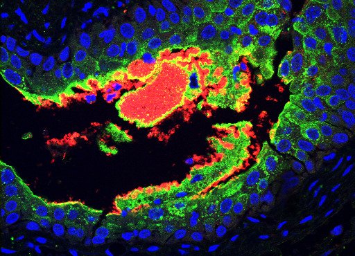 Bilden visar stora klumpar av E. coli (i rött) som infekterar urinblåsan hos en mus med diabetes.