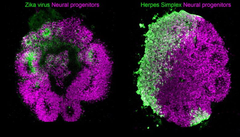 Hjärnorganoider med färgade markörer för stamceller (magenta) och zikavirus (grönt t.v.) och herpessimplexvirus (grönt t.h.).