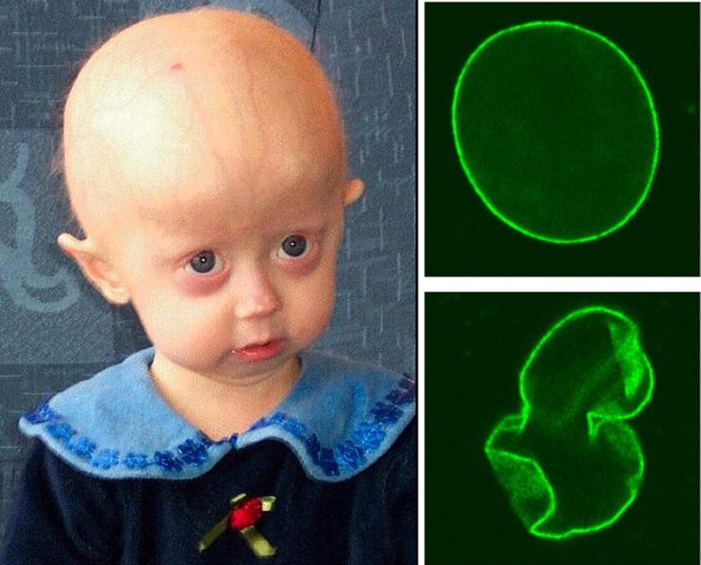 Bild på barn med progeria och cellkärnan hos en sjuk respektive frisk individ