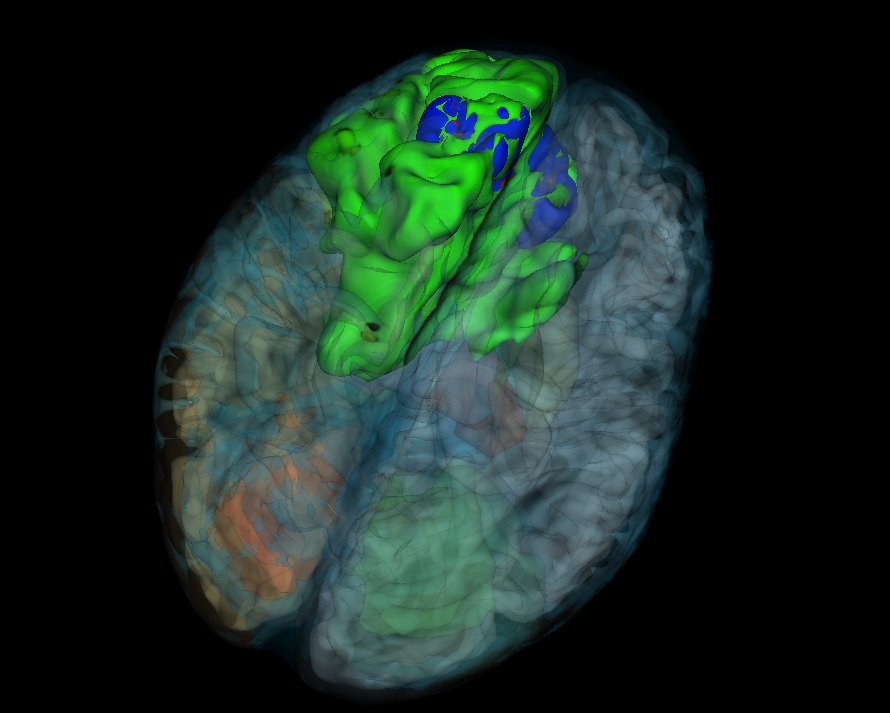 En datorgenererad 3D-visualisering av en hjärna från en patient med gliom där tumören är röd, den nekrotiska kärnan blå och ödemet grönt.