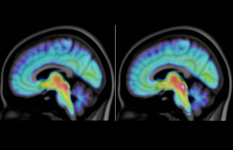 En visualisering av den genomsnittliga koncentrationen av serotonintransportör i hjärnan i gruppen med ASD, autismspektrumtillstånd (till vänster) och gruppen utan ASD (till höger). Grafik: Max Andersson