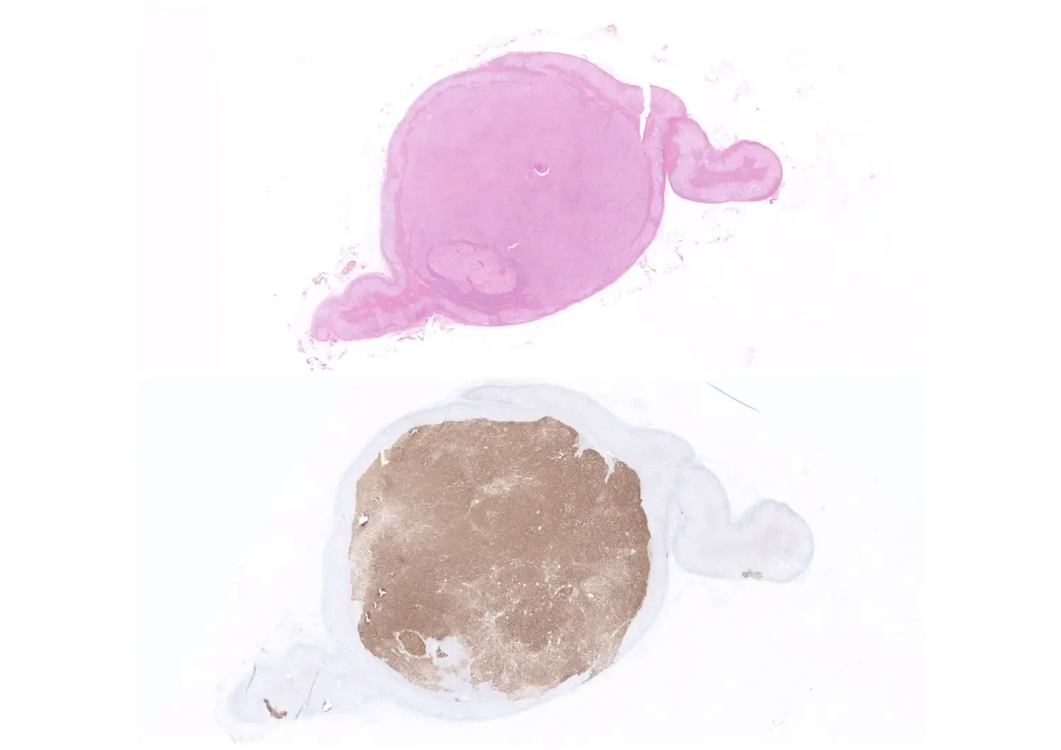 Histologisk bild av en tumör i binjuren, färgad på två olika sätt.