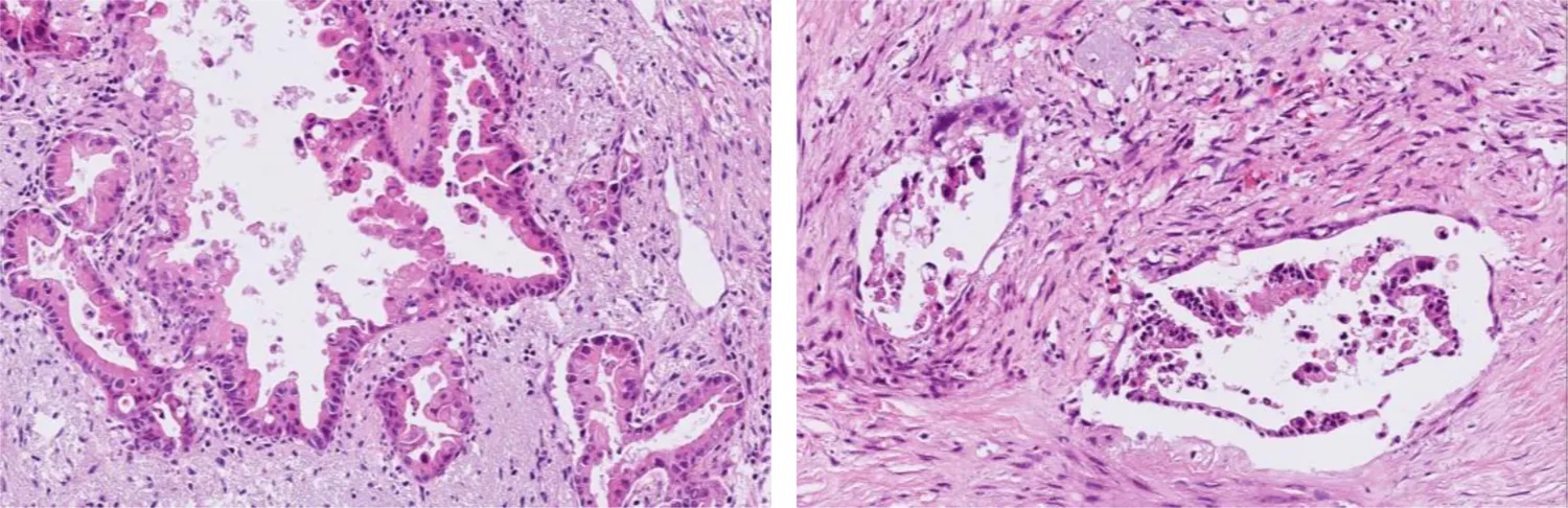 Bild på tunna skivor av tumörvävnad från patienter med bukspottkörtelcancer. Till vänster ses obehandlad vävnad och till höger vävnad som behandlats med natriumselenit. Behandlingen gav tydliga tecken på att tumören minskade.