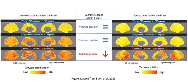 Bild som visar att hög ackumulering av tau i hjärnan mätt med PET-kamera var den enda biomarkör som kunde förutsäga kognitiv försämring hos friska individer, personer med mild kognitiv nedsättning och personer med Alzheimerdemens.
