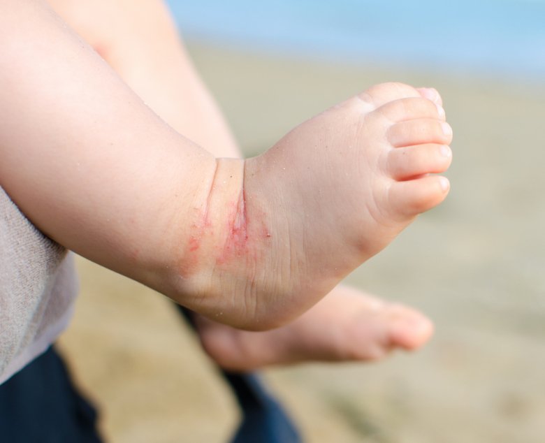 Photo of baby with eczema.