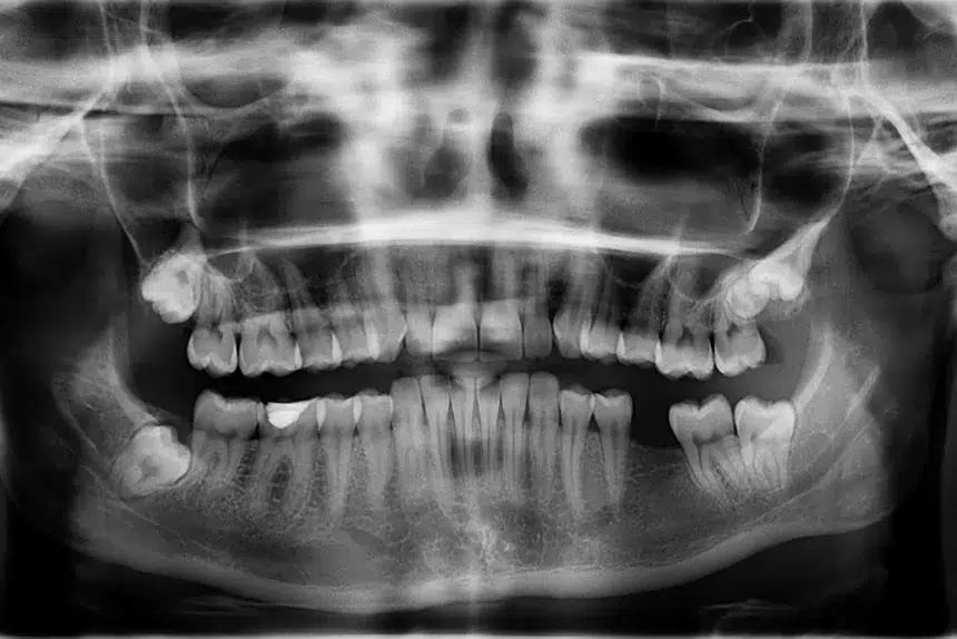 en röntgenbild på tänder