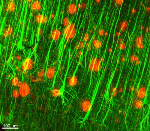 Large pyramidal neurons (green) and dense amyloid plaques (red)  in the cortex of a person who died in Alzheimer’s disease.