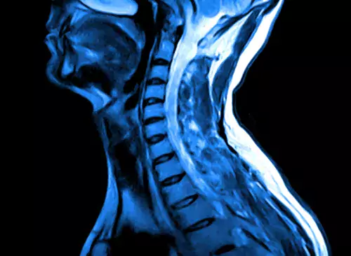 MRI of the cervical spine