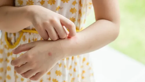 Little girl has eczema and scratching on her arm