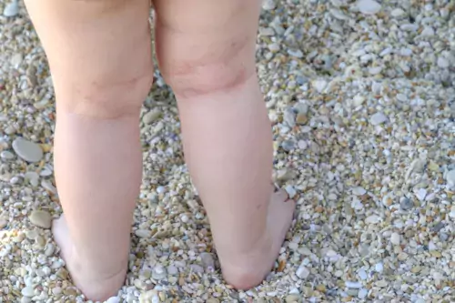 Photo of child&#039;s legs with atopic eczema.