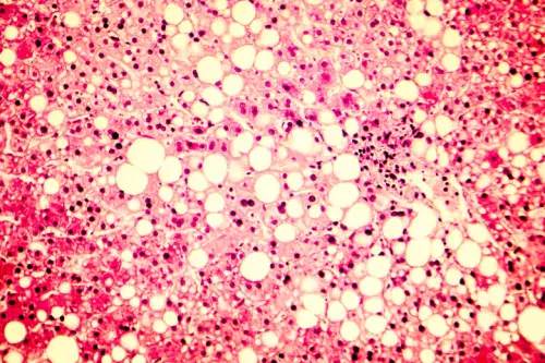 Fat accumulated in liver cells