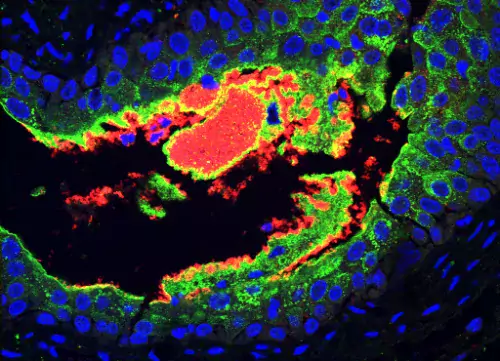 Bilden visar stora kluThe image shows a huge clumps of E. coli (red) infecting diabetic mouse bladder.mpar av E. coli (i rött) som infekterar urinblåsan hos en mus med diabetes.