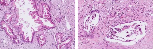 Image of Thin sections of tumour tissue from patients with pancreatic cancer. On the left is untreated tissue and on the right is tissue treated with sodium selenite. Under the microscope, the treated tissue showed clear signs of tumour shrinkage.